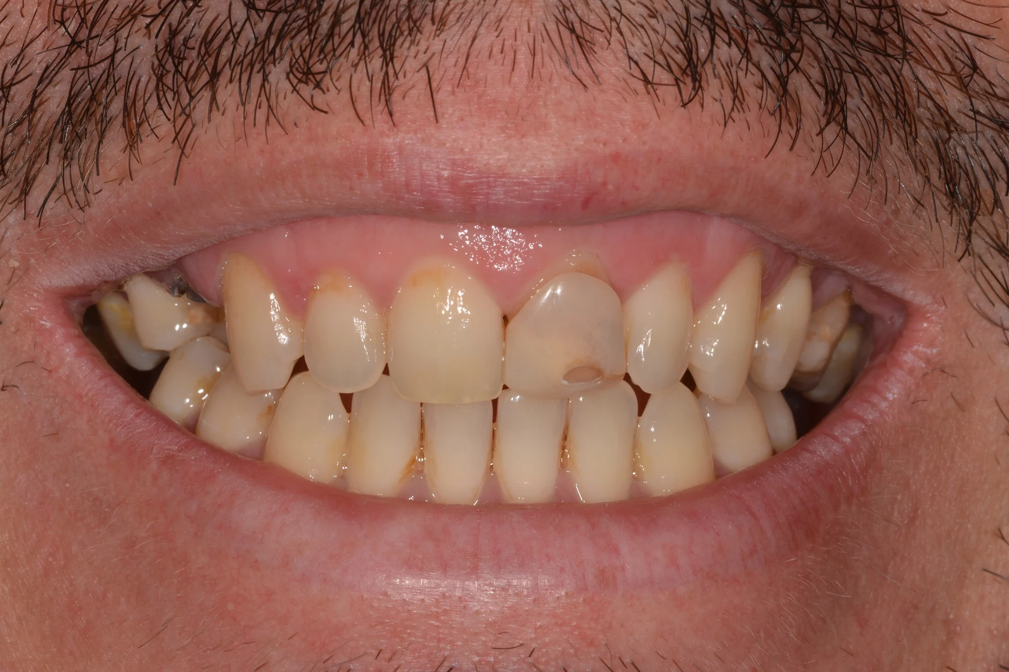 AfterOld crown removed a new aesthetic all ceramic crown was provided