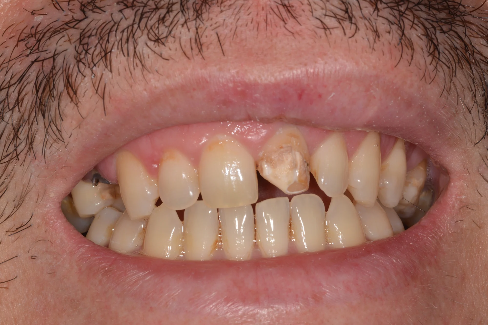 BeforePatient presented with a failing crown on his front tooth.