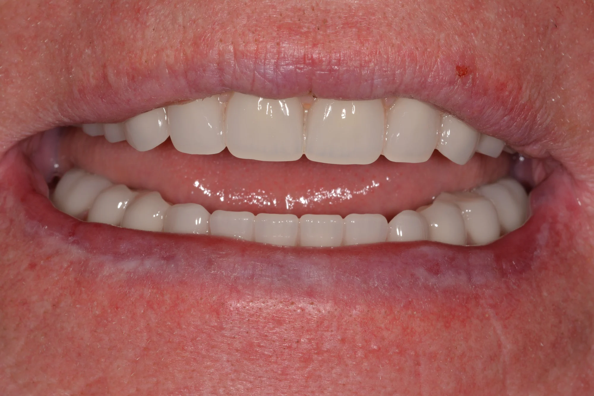 BeforeIn the lower arch he was provided with two implants and an implant supported denture.