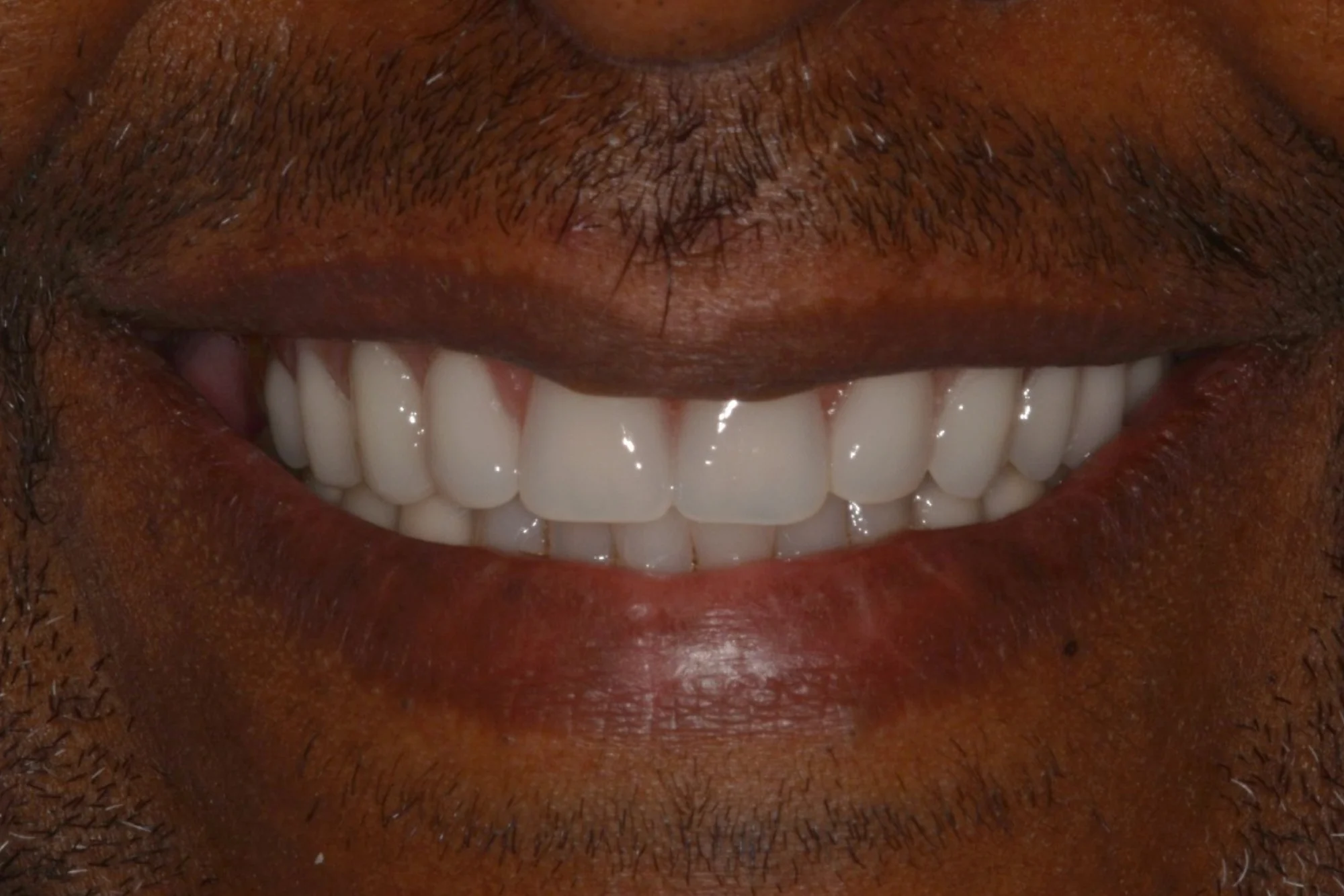AfterGum disease was treated, and patient provided with a full upper arch rehabilitation with a fixed in implant supported bridge.