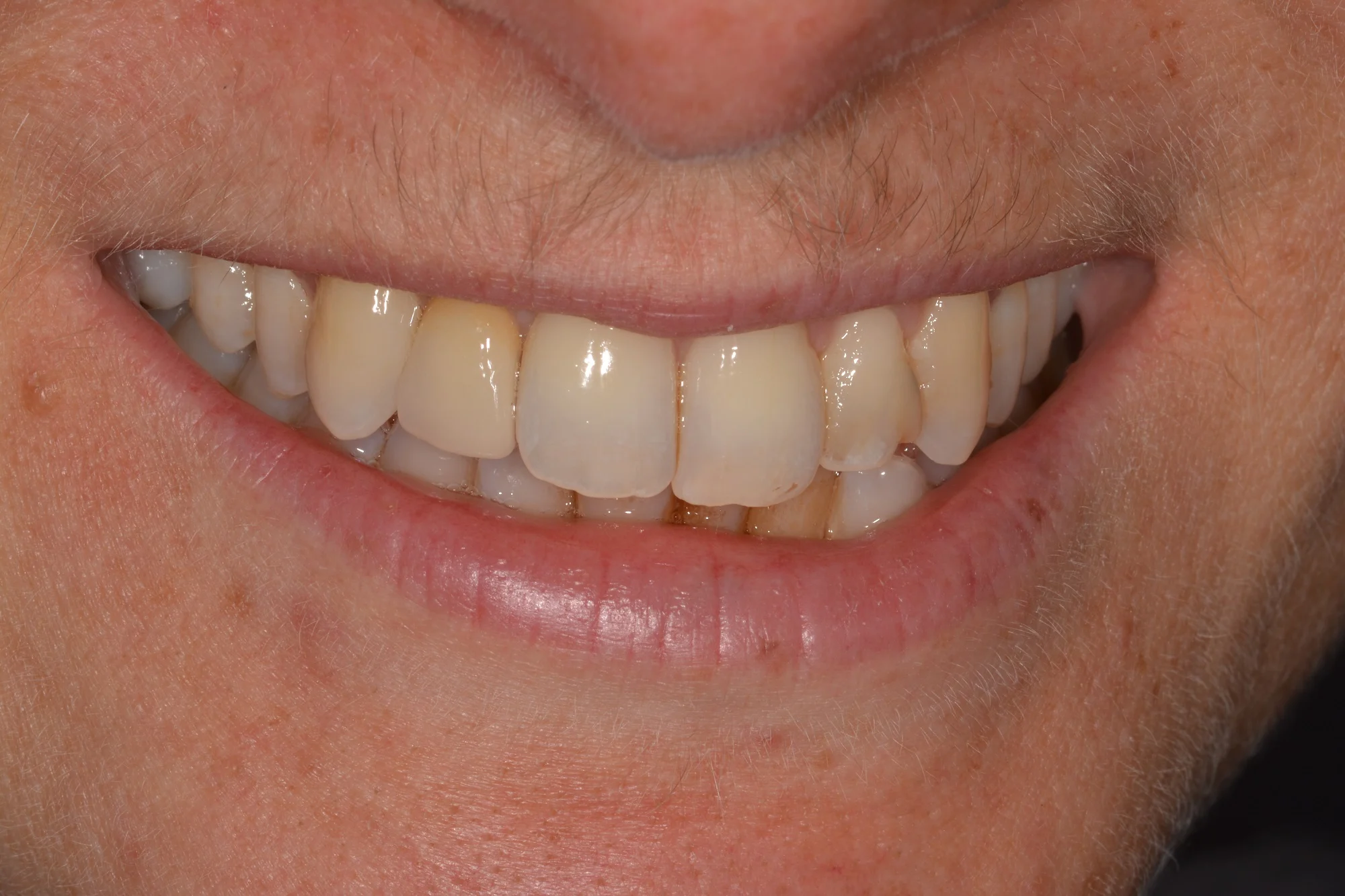 AfterGum disease was treated, and patient provided with a full upper arch rehabilitation with a fixed in implant supported bridge.