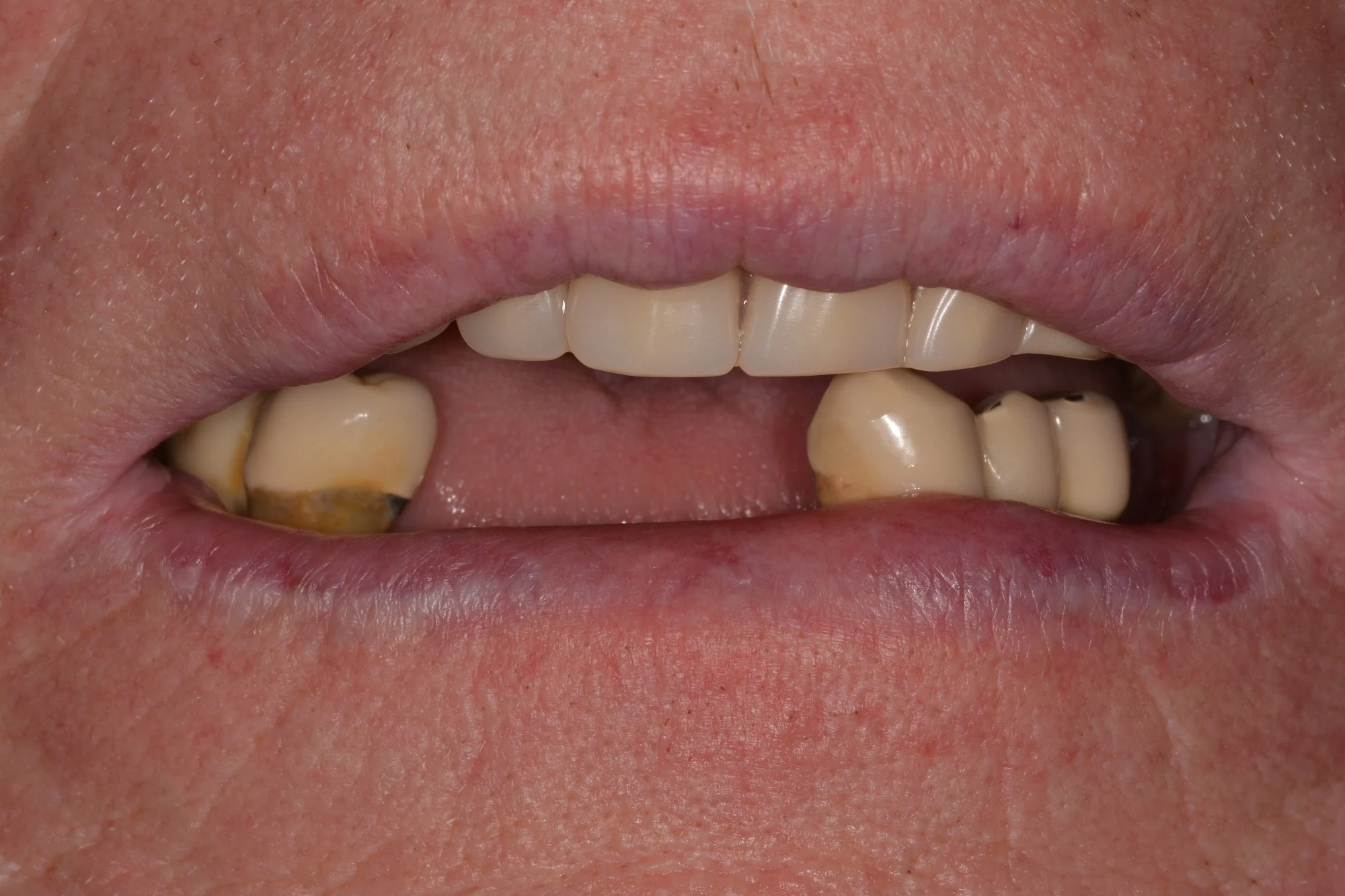BeforePatient presented with a failing upper denture and lower failing old bridges. All teeth were removed, and the patient was provided with an upper of denture with good retention and stability and excellent naturally looking teeth.