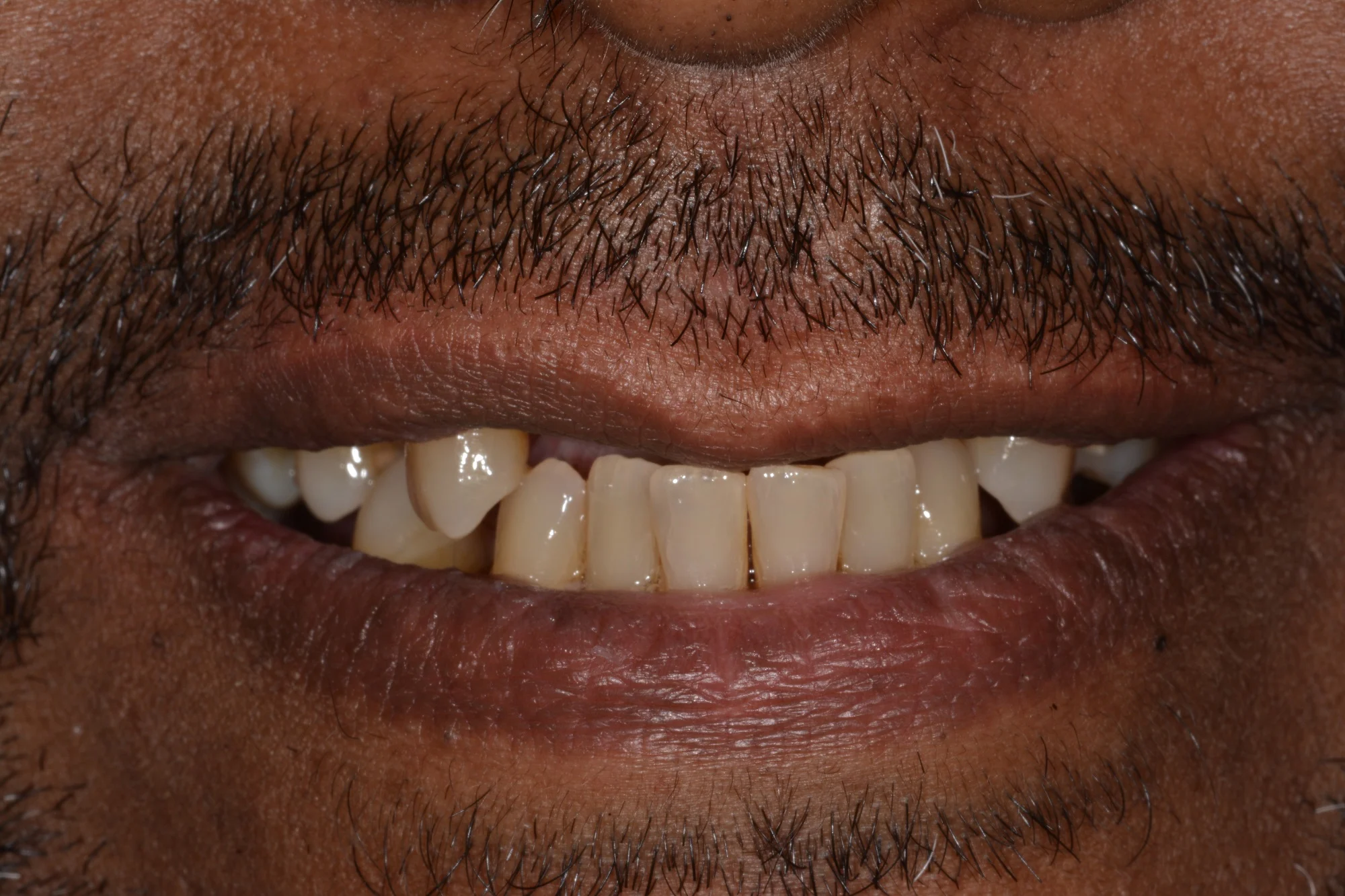 BeforePatient presented with gum disease and multiple missing teeth.