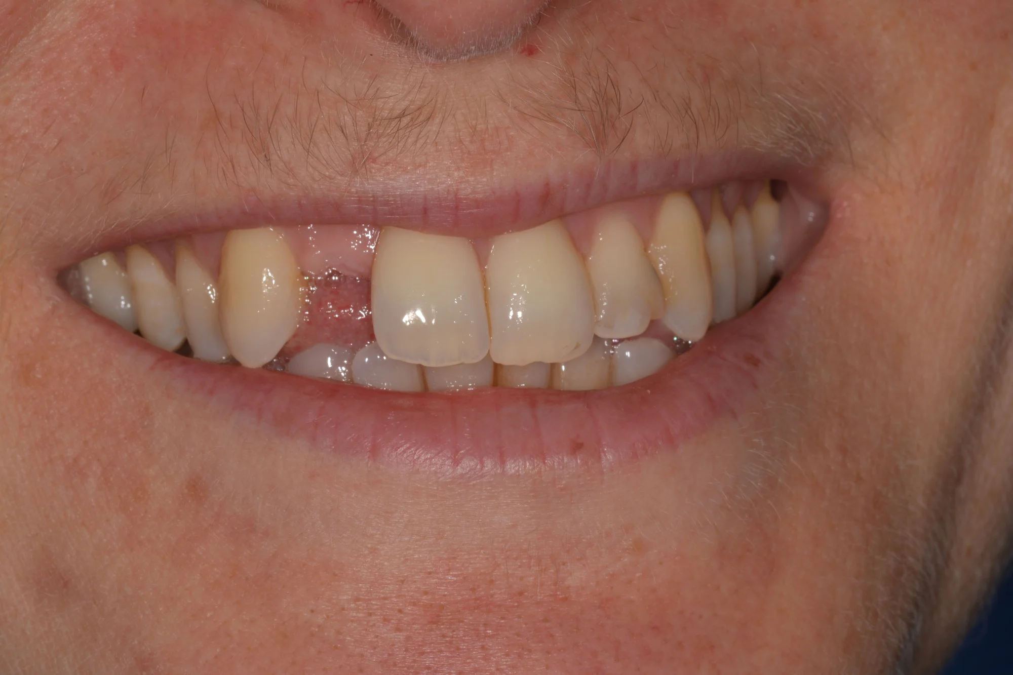 BeforePatient presented with gum disease and multiple missing teeth.